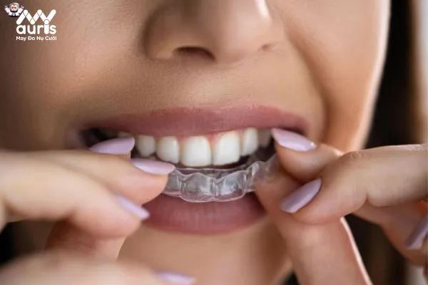 Niềng răng giữ răng khểnh với những phương pháp nào?