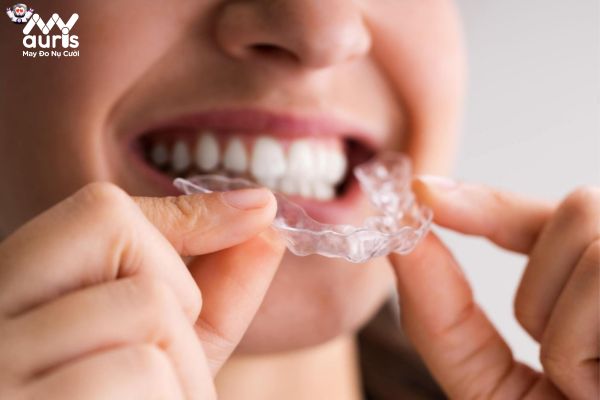 Niềng răng giữ răng khểnh thì cần chú ý điều gì?