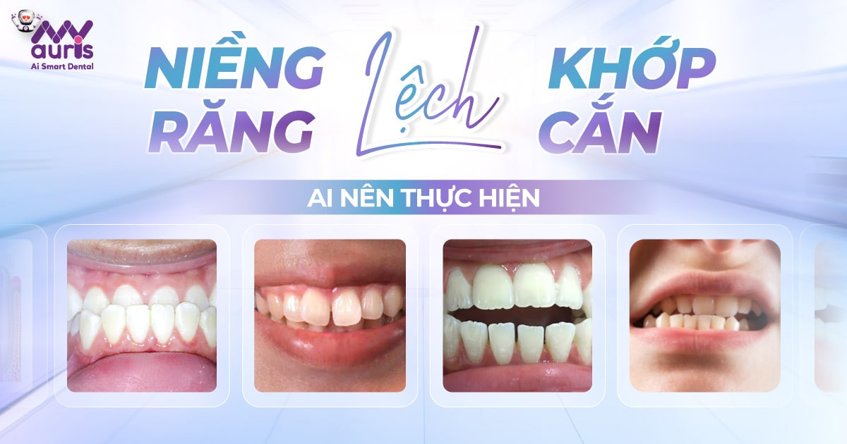 Niềng răng lệch khớp cắn - 4 trường hợp nên thực hiện