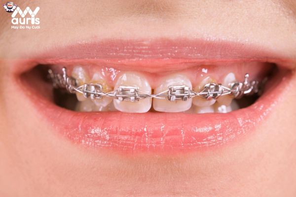 Niềng răng không đúng kỹ thuật có thể làm răng dịch chuyển về vị trí cũ