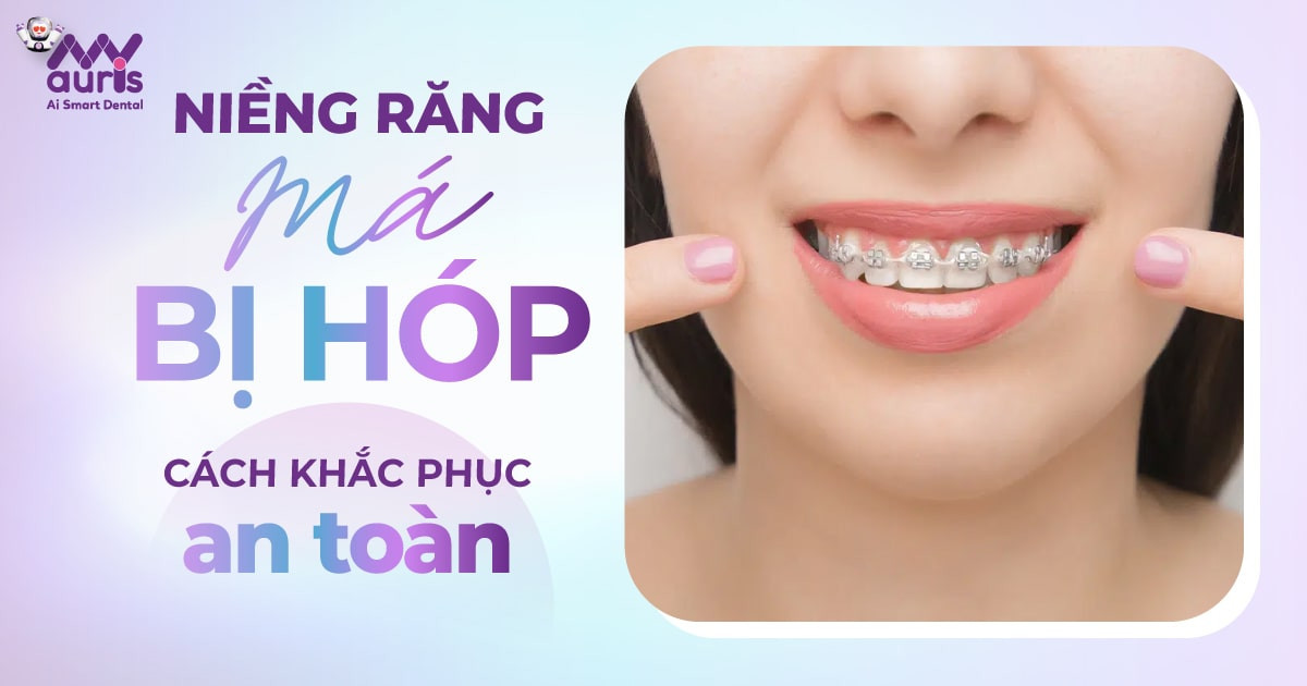 Niềng răng má bị hóp - 4 cách khắc phục an toàn