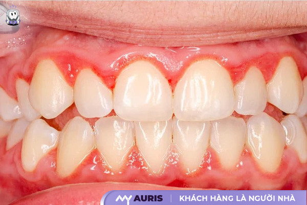thuốc bôi chữa tụt lợi,tụt lợi,tụt lợi là gì,bị tụt lợi,răng bị tụt lợi,tụt lợi chân răng
