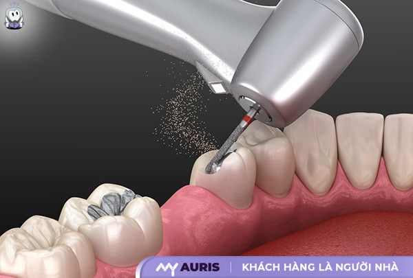 thuốc bôi chữa tụt lợi,tụt lợi,tụt lợi là gì,bị tụt lợi,răng bị tụt lợi,tụt lợi chân răng