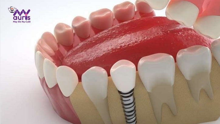 trồng răng công nghệ implant