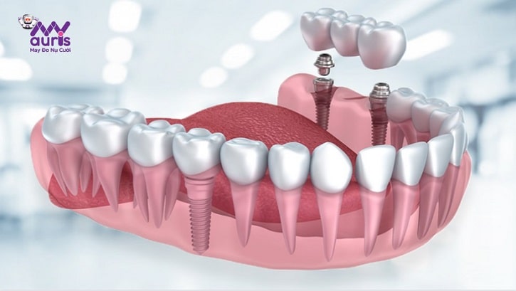 trồng răng công nghệ implant