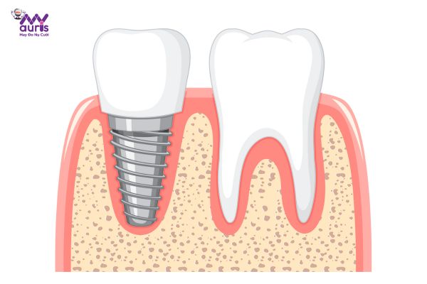trồng răng implant ở đâu tốt tphcm 