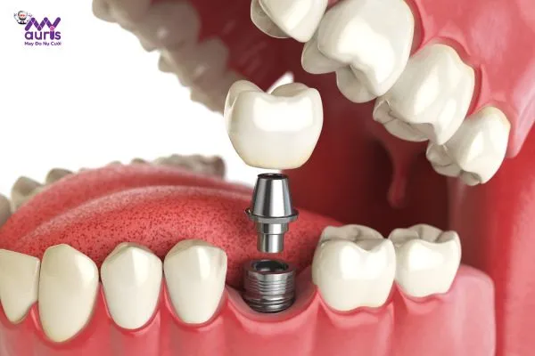  trồng răng implant ở đâu tốt tphcm 