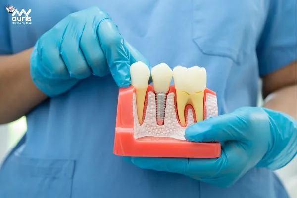 Giá trồng răng implants như thế nào?