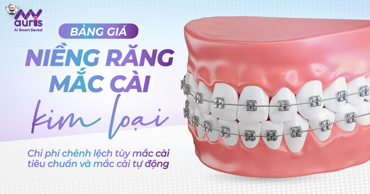 Bảng giá niềng răng mắc cài kim loại