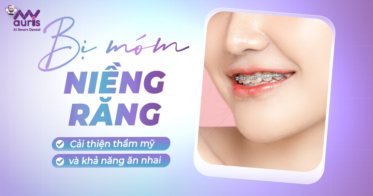 [Giải đáp nha khoa] Bị móm có niềng răng được không?