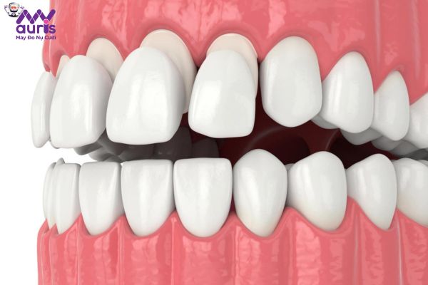 Chi tiết bọc răng sứ 1 hàm bao nhiêu tiền?