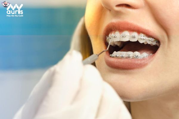 Giải đáp nha khoa: Bọc răng sứ có niềng răng được không?