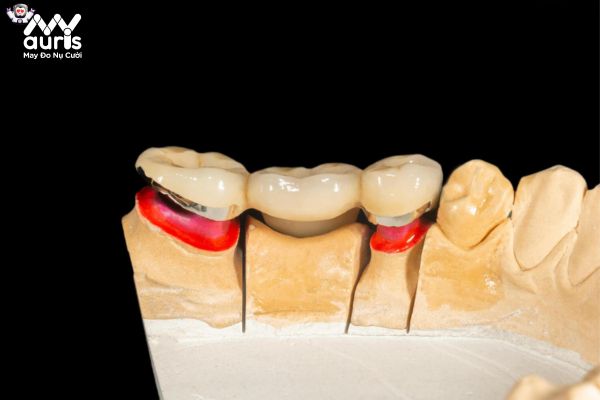 Cách trồng răng sứ Titan với kỹ thuật cầu răng sứ
