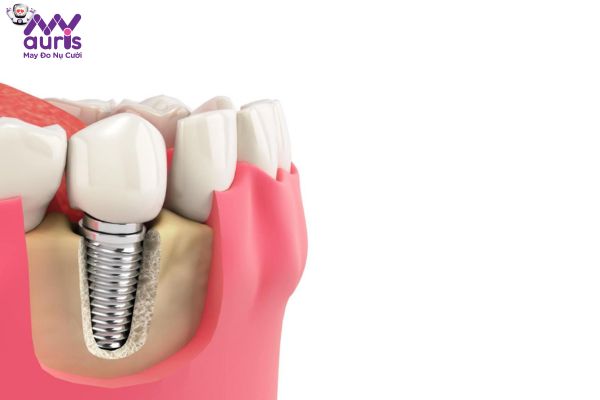 Quy trình phục hình với trồng răng Implant 