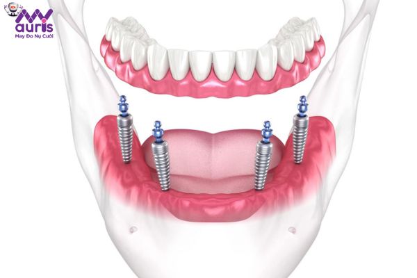 Cắm Implant nguyên hàm là phương pháp gì?