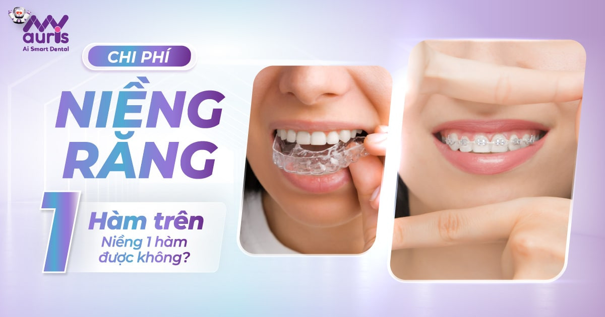 Chi phí niềng răng 1 hàm trên