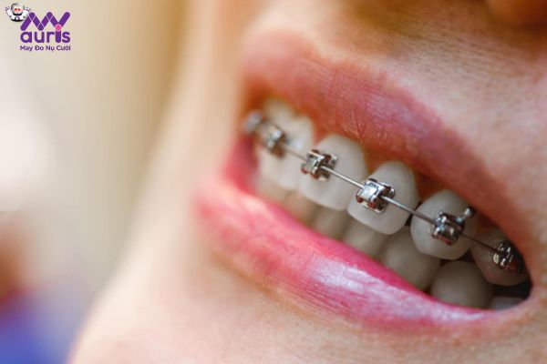 Chi phí niềng răng 1 hàm có tiết kiệm hơn so với niềng răng 2 hàm không?
