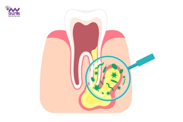 điều trị tủy có đau không