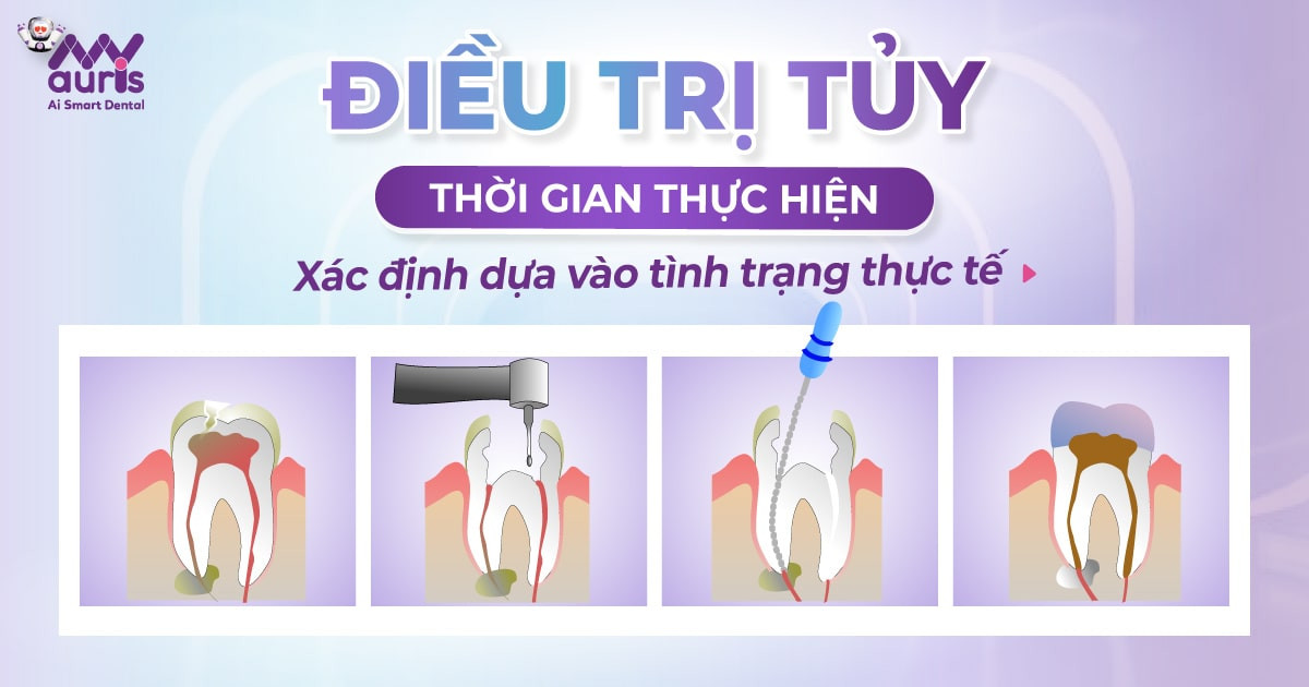 [Tư vấn nha khoa] Điều trị tủy răng mất bao lâu?