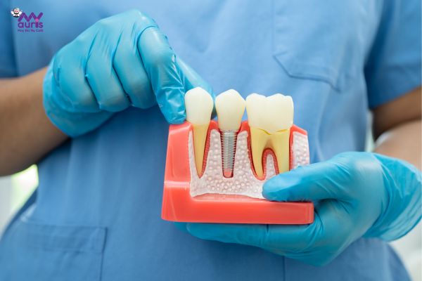 giá cấy răng implant 