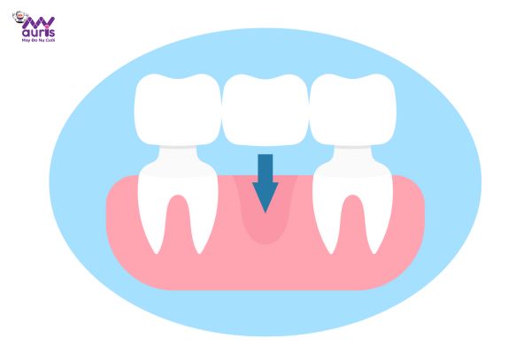 Phương pháp trồng răng sứ cố định 