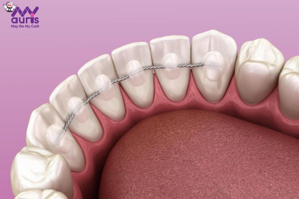 Hàm duy trì cố định với ưu điểm duy trì ổn định răng liên tục 