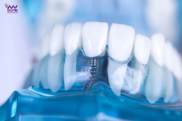 kỹ thuật trồng răng implant 