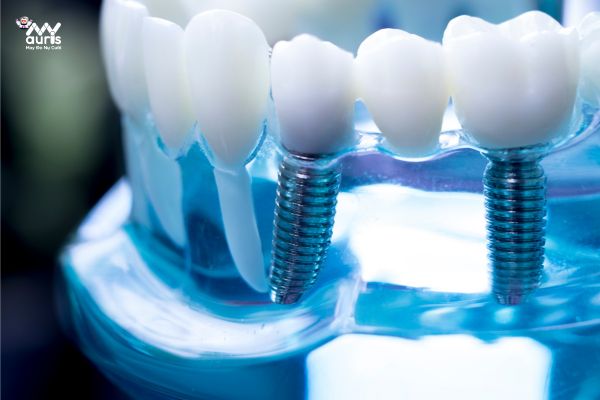 kỹ thuật trồng răng implant 