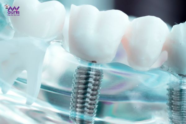 kinh nghiệm trồng răng implant 