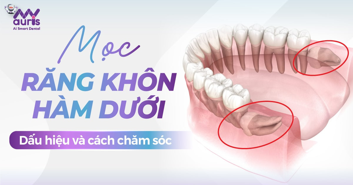 Mọc răng khôn hàm dưới