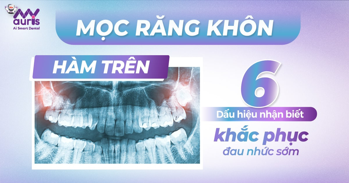 Mọc răng khôn hàm trên