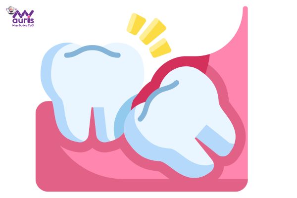 Nhổ răng khôn bao lâu thì lành?