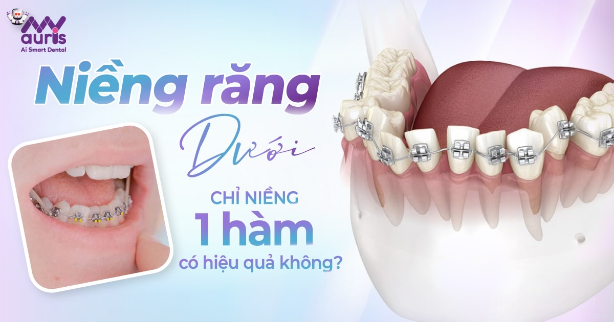 Niềng răng dưới - Chỉ niềng 1 hàm có hiệu quả không?