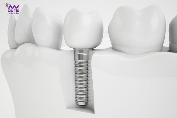 Trồng răng implant đơn lẻ - Trường hợp nên niềng răng giả 