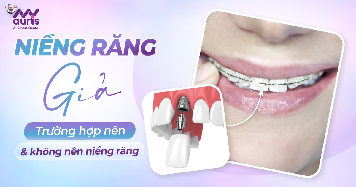 Niềng răng giả