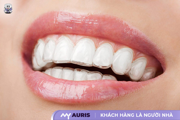 niềng răng trong suốt và niềng răng mắc cài