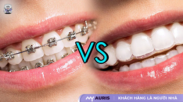 niềng răng trong suốt và niềng răng mắc cài