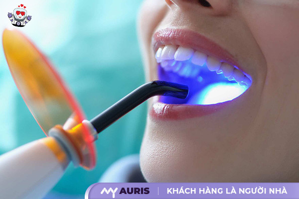 Tẩy trắng răng sứ bằng phương pháp laser