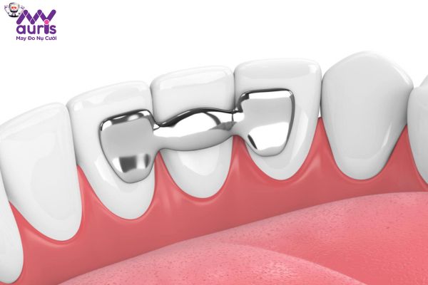 Chi phí trồng răng cửa bị ảnh hưởng từ các yếu tố nào?