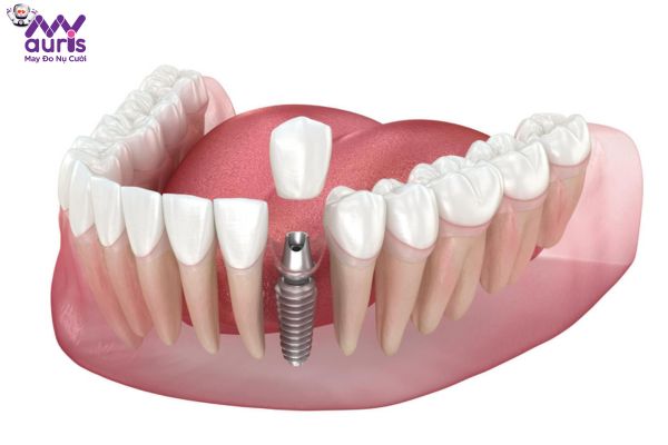 Nên trồng răng cửa với phương pháp nào tốt nhất?