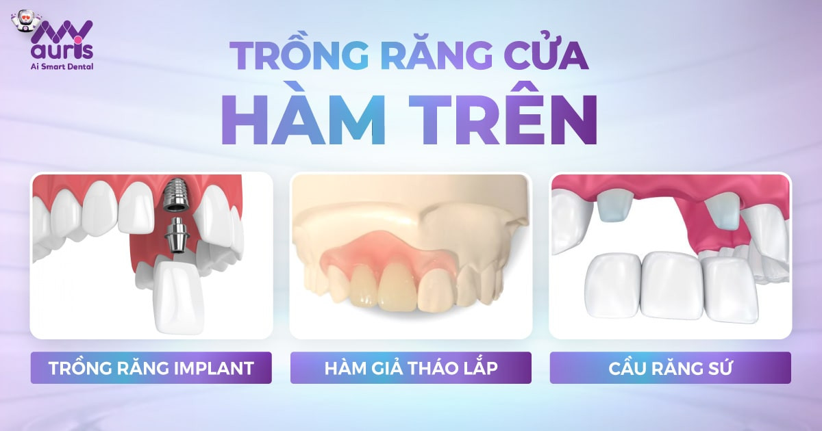 Trồng răng cửa hàm trên với 3 phương pháp phục hình