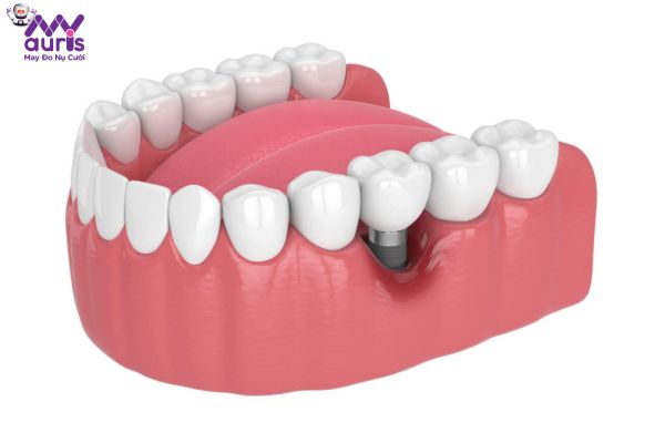 Các phương pháp hỗ trợ phục hình răng mất trên cung hàm - Trồng răng Implant