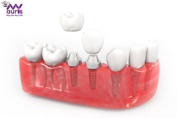 Tìm hiểu trồng răng Implant có kiêng ăn gì không?