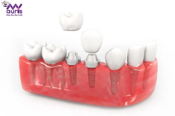 Tìm hiểu trồng răng Implant có kiêng ăn gì không?