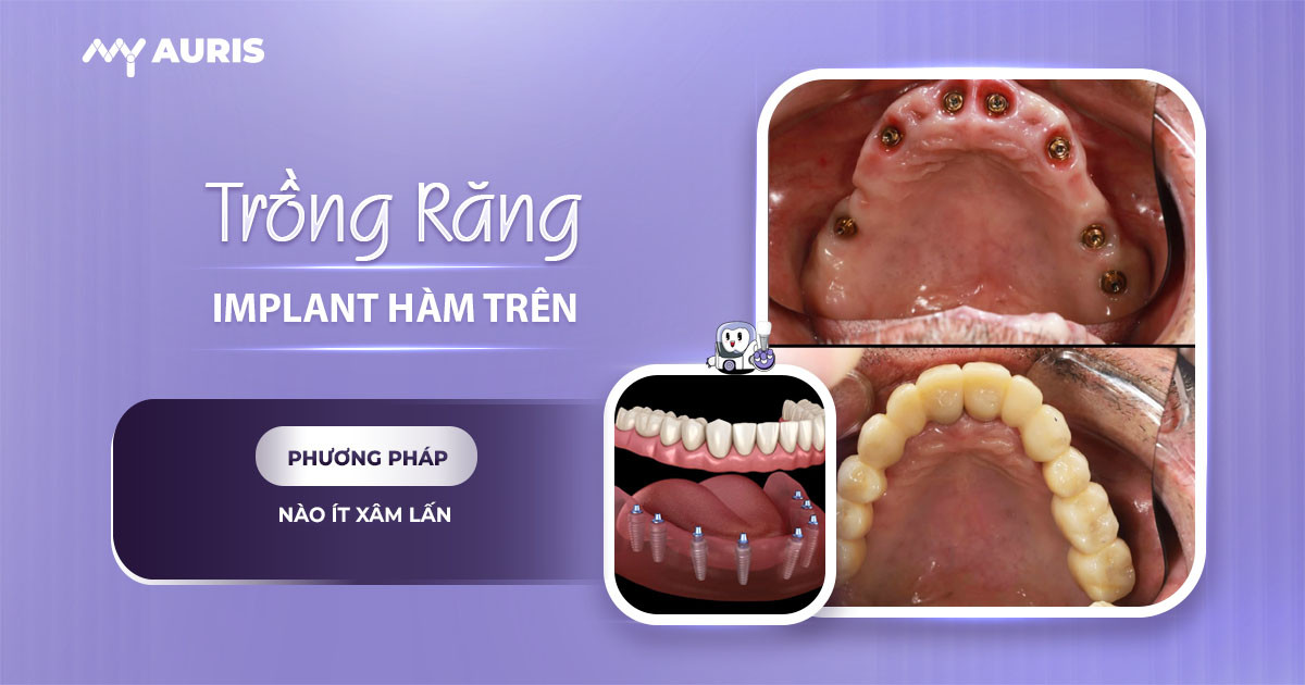 trồng răng Implant hàm trên,cắm implant hàm trên,cắm implant răng hàm