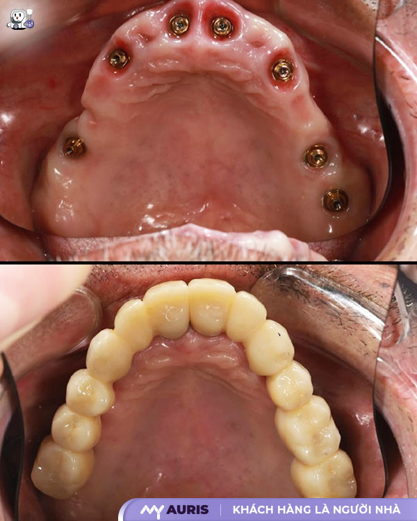 trồng răng Implant hàm trên,cắm implant hàm trên,cắm implant răng hàm