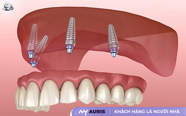 trồng răng Implant hàm trên,cắm implant hàm trên,cắm implant răng hàm