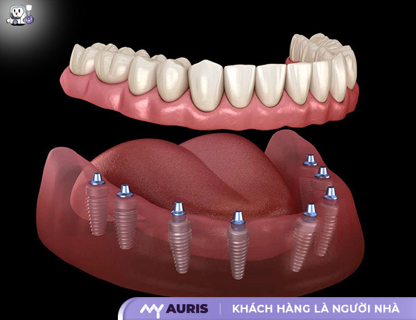 trồng răng Implant hàm trên,cắm implant hàm trên,cắm implant răng hàm