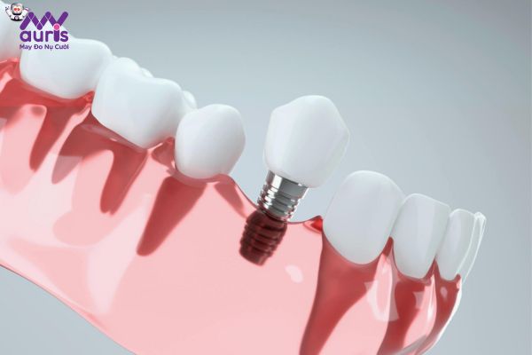 Tìm hiểu trồng răng Implant không đau là phương pháp gì?