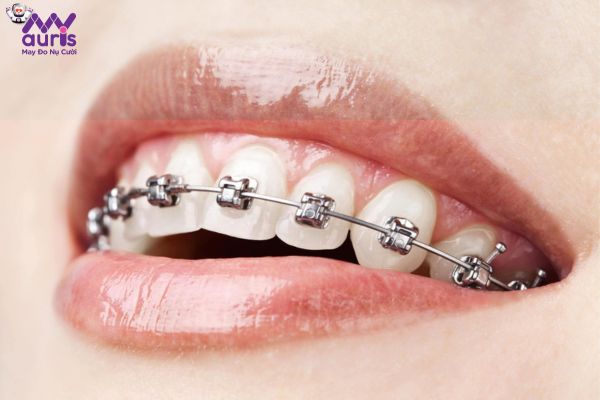 Kỹ thuật niềng răng phù hợp cho người đã trồng răng sứ - Niềng răng mắc cài